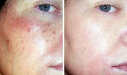 5 sản phẩm chống nếp nhăn có tác dụng không kém việc tiêm thuốc làm đẹp