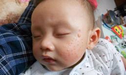 Trên khuôn mặt của trẻ có 3 điểm lạ, cha mẹ cần chú ý, rất có thể lá lách và dạ dày bị tổn thương, ảnh hưởng nghiêm trọng tới sức khỏe