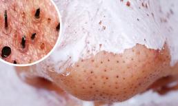 Mẹo thu hẹp lỗ chân lông, giúp da mềm mịn tươi sáng mà bạn có thể làm tại nhà