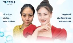 Trẻ hóa nguyên bào Revi Cell dẫn đầu xu hướng làm đẹp an toàn giúp phụ nữ Việt loại bỏ gò má cao