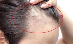 Làm gì nếu tóc mỏng và không dày? Làm tốt 5 điều này, tóc bạn sẽ mọc dày lên