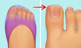 Làm thế nào để ngăn ngừa móng chân mọc ngược