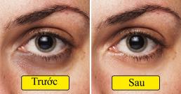  8 cách rẻ tiền nhưng đã được chứng minh giúp loại bỏ quầng thâm dưới mắt