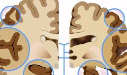 Teo não không hẳn là rút ngắn tuổi thọ, có người có thể sống hàng chục năm, mấu chốt là phải xem được nguyên nhân gây ra bệnh teo não
