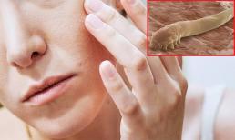 Mặt lúc nào cũng tiết dầu, mụn mọc nhiều lần, có thể bị con mạt bụi tạo lỗ trên mặt, 4 mẹo loại bỏ chúng