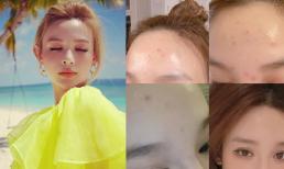Huyền Baby đăng cận cảnh mặt nổi mụn chi chít sau khi đi du lịch, fan cũng xót thay 