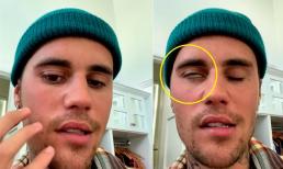 Justin Bieber chia sẻ về bệnh liệt nửa mặt do nhiễm virus hiếm