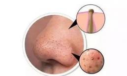 Mụn đầu đen ngày càng nhiều, hóa ra liên quan đến 4 phương pháp sai lầm của chị em nhưng nhiều người không hay biết