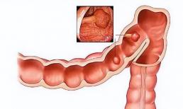 Tại sao ruột dễ bị 'polyp'? Nếu có polyp trong ruột thì cơ thể có những biểu hiện gì?