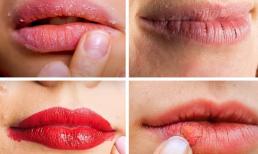 Mùa hè môi thường bị khô, xỉn màu, gợi ý bạn cách chăm sóc để đôi môi luôn mịn màng