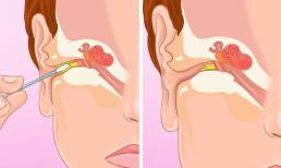 Tại sao bạn nên ngừng vệ sinh tai bằng tăm bông và làm gì để thay thế?