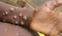 Bệnh đậu mùa khỉ được liệt kê là loại bệnh truyền nhiễm chính thức thứ hai, và các trường hợp nghi ngờ phải được thông báo trong vòng 24 giờ