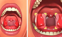 Sỏi amidan là gì và nguyên nhân gây ra chúng