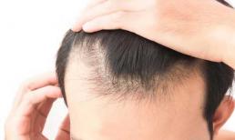 Rụng tóc, tóc bạc ám chỉ điều gì về cơ thể? Hiểu rõ những yếu tố này, đừng để bệnh hiểm nghèo ập đến cửa nhà bạn