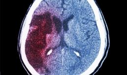 Xuất huyết não 'giết người nhanh nhất', có 4 tín hiệu trước khi khởi phát, mỗi tín hiệu rất dễ bị bỏ qua! 