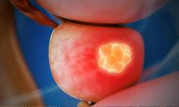 Nam giới chú ý: dấu hiệu này xuất hiện trong quá trình “xuất tinh”, cẩn thận ung thư tuyến tiền liệt đã “tiềm ẩn”