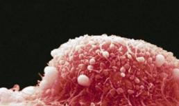 Nếu trên quần lót xuất hiện một 'đốm nhỏ' như vậy, đừng bất cẩn, nó có thể là dấu hiệu báo trước của 'bệnh cổ tử cung'