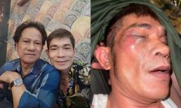 Con trai của danh ca Chế Linh bất ngờ bị đánh hội đồng, hàng loạt vết thương gây lo lắng 