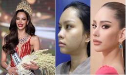 Tân Hoa hậu Hoàn vũ Thái Lan lộ ảnh phẫu thuật thẩm mỹ