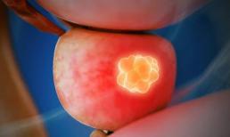 Chú ý của nam giới: dấu hiệu này xuất hiện trong quá trình “xuất tinh”, hãy cẩn thận ung thư tuyến tiền liệt đã “tiềm ẩn”