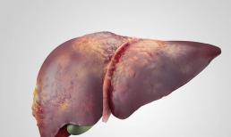 2 bộ phận trên cơ thể bị “ngứa” thì 80% là dấu hiệu của bệnh gan giai đoạn cuối! Lời khuyên: 4 điều nhanh loại khỏi bàn ăn