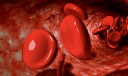 Người phụ nữ 42 tuổi không bao giờ ăn thịt mỡ nhưng bị nhồi máu não và liệt nửa người. Bác sĩ: 'Ăn chay 2 loại, tương đương với uống dầu'