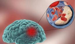 “Chất gia tốc” cho bệnh nhồi máu não không chỉ là muối, bác sĩ nhắc nhở: ba loại gia vị này cho vào nồi càng ít càng tốt