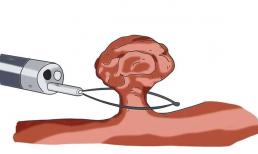 Nếu có 'polyp' trong ruột, cơ thể sẽ có những triệu chứng gì? Nhiều người đang trong nhận thức muộn màng