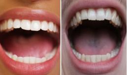 Làm thế nào để ngăn ngừa ung thư miệng trong cuộc sống hàng ngày, thực hiện bốn điểm sau để ngăn ngừa ung thư miệng! 