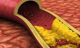 Bệnh mỡ máu có những biểu hiện này, đề phòng biến chứng, làm tốt những điều sau và giảm mỡ máu