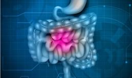 Tỷ lệ mắc ung thư đại tràng cao nên cảnh giác, 5 loại bất thường này có thể là cánh cửa dẫn đến ung thư ruột kết
