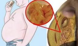 Kiểm tra đơn giản: Bạn có nhiều 'mỡ nội tạng' không? Hướng dẫn bạn 5 bí quyết 'giảm béo dễ dàng' để eo thon bụng nhỏ