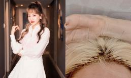 Hậu bị liệt nửa bên mặt, Hari Won tiếp tục gây lo lắng khi hé lộ hình ảnh đầu đầy kim châm cứu
