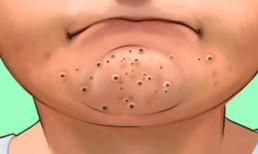 Làm thế nào để thoát khỏi mụn đầu đen ở cằm một lần và mãi mãi