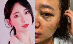 Nữ idol Kpop Seo Sa Rang bị chồng doanh nhân nhiều lần bạo hành