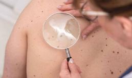 Bác sĩ nhắc nhở: Nếu nốt ruồi đen mọc ở các bộ phận này trên cơ thể, bạn cần cảnh giác hơn