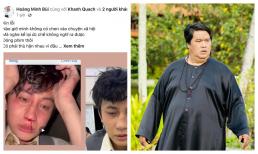 Hoàng Mập bức xúc vì một diễn viên trẻ bị chèn ép đến gãy mũi, tuyên bố hỗ trợ tiền điều trị làm mũi mới