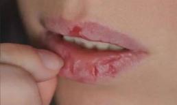 Môi bong tróc vào mùa thu? Hãy áp dụng kiến ​​thức này! 