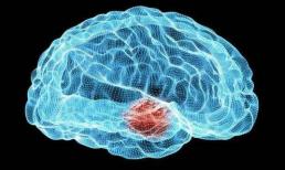 Những người không được cung cấp đủ máu lên não rất có thể sẽ có 3 dấu hiệu này, nếu xuất hiện liên tục thì cần đi khám kịp thời