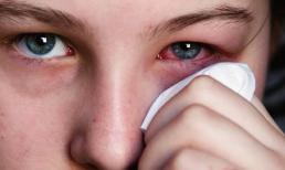 4 kỹ thuật để giảm sưng húp mắt, làm thế nào để thực hiện tại nhà?