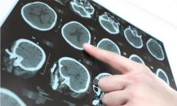 9 triệu chứng gợi ý 'lượng máu cung cấp lên não không đủ'! Không muốn nhồi máu não hay sa sút trí tuệ khi về già, hãy làm 4 điều sau 