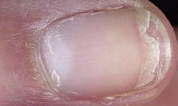  5 triệu chứng bất thường này xuất hiện nhắc nhở bạn rằng đã đến lúc cần phòng ngừa loãng xương