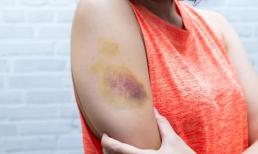 Tổng hợp 4 cách chữa vết thâm, bầm tím nhanh chóng, dễ dàng thực hiện tại nhà