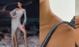 Trước thềm Chung kết Miss Intercontinental, Á hậu Bảo Ngọc gây lo lắng khi bị bầm dập khắp nơi trên cơ thể