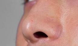 Lông mũi mọc ngoài lỗ mũi có nhổ hay tỉa được không? Lông mũi dài quá, có chuyện gì vậy?