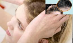 Gàu đến từ đâu? Các bác sĩ da liễu dạy bạn hai thủ thuật để loại bỏ tóc gàu