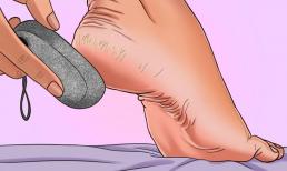 7 cách điều trị nứt gót chân không tốn kém trong thời tiết khô lạnh