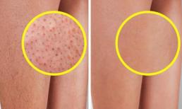 7 cách dễ dàng để loại bỏ 'hiệu ứng dâu tây' trên da của bạn