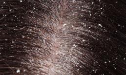 5 cách trị gàu đơn giản bằng nguyên liệu tự nhiên, kết hợp với dưỡng tóc mượt mà trong mùa thu đông