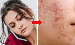 Mụn trứng cá trên 8 bộ phận cơ thể có thể tiết lộ về thói quen của bạn
